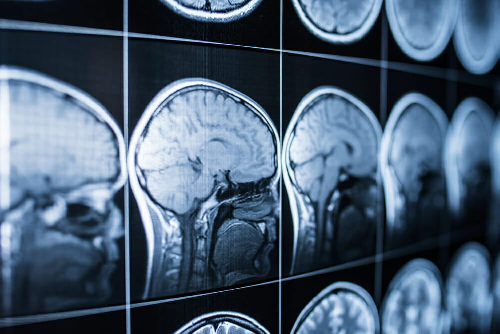 Glenn Faegenburg Discusses Mild Traumatic Brain Injuries