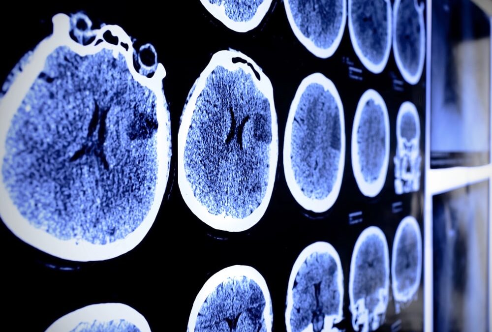 Common Causes Of Brain Injuries In Motor Vehicle Collisions