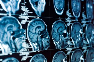 Types of TBI Cases We Handle