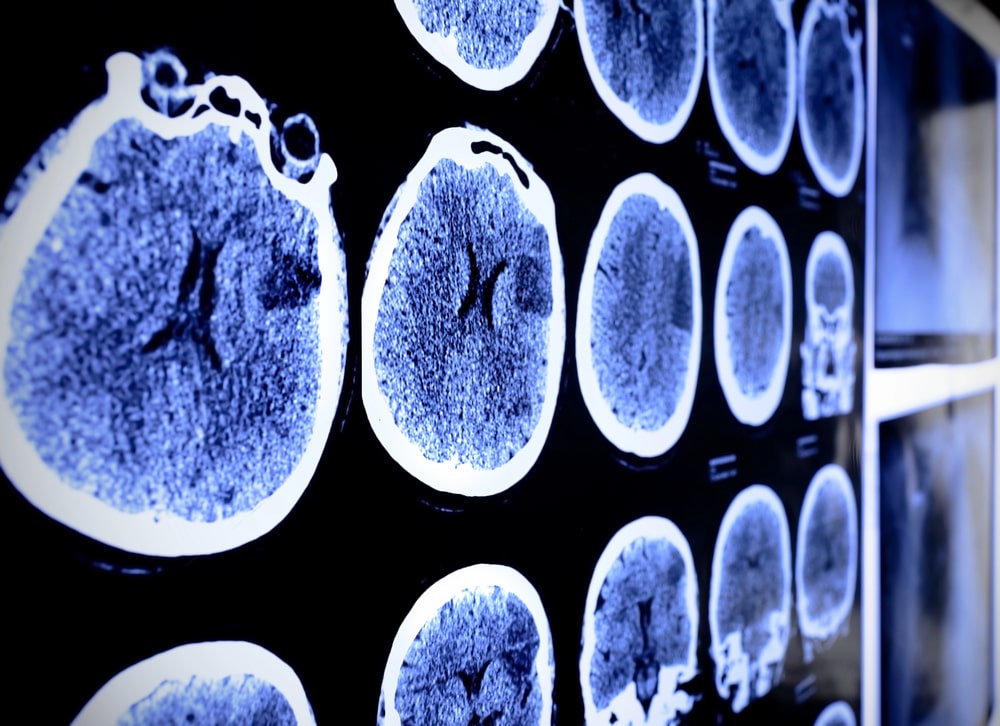 TBI lawyer Manhattan, NY